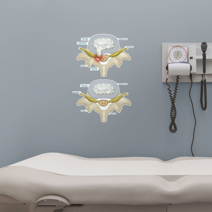 Body Part Chart:  Prolapsed Disc        -   Removable     Adhesive Decal