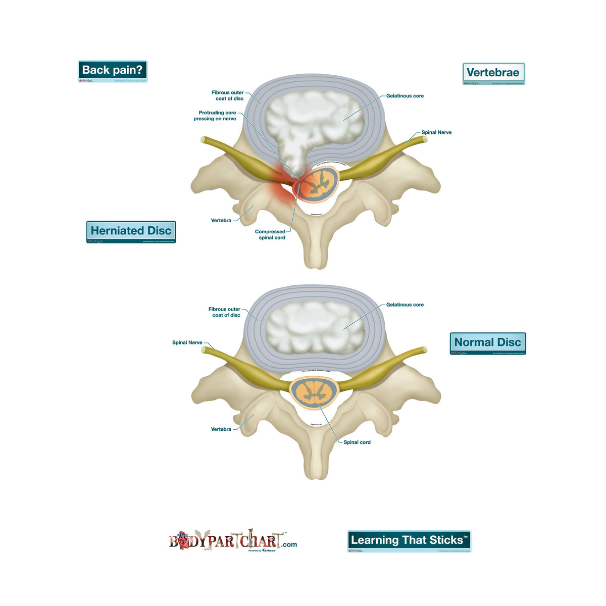 Prolapsed Disc Device Prolapsed Disc